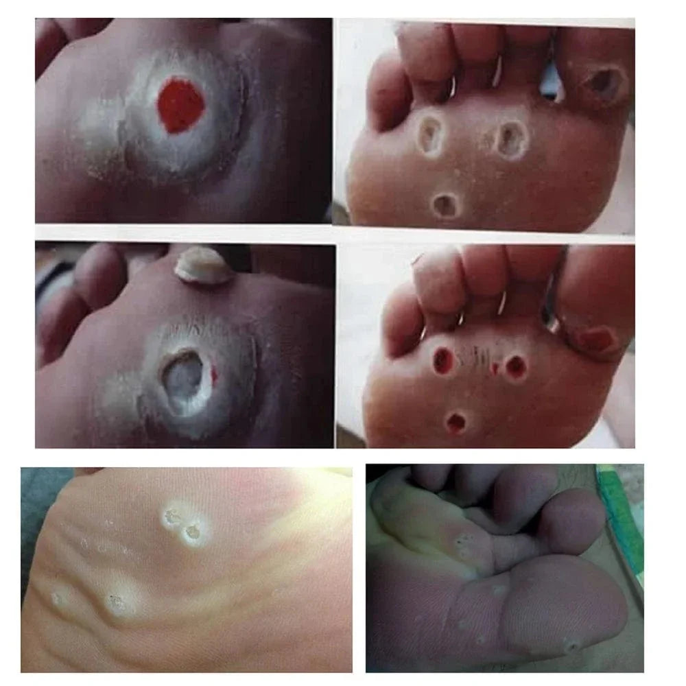 Wart Remover Patch – Fast & Gentle Treatment