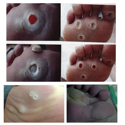 Wart Remover Patch – Fast & Gentle Treatment