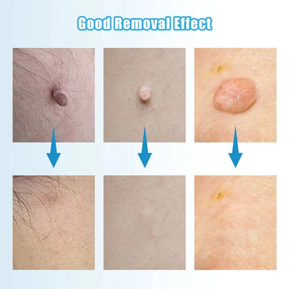 Manual Wart Removal Device At Home