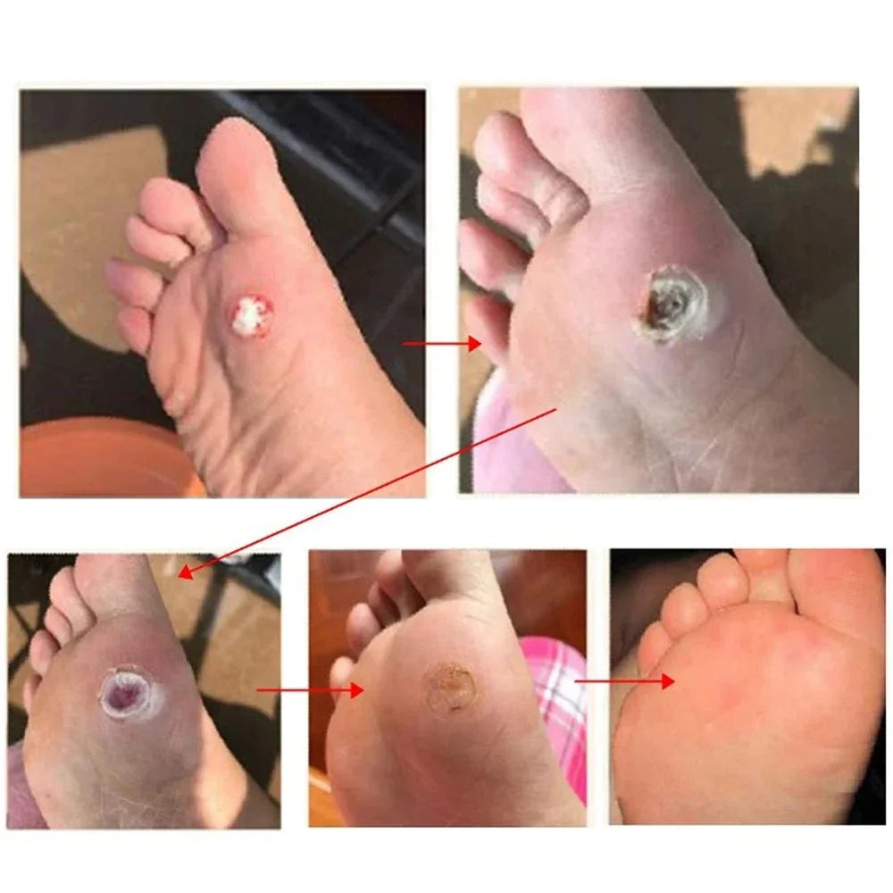 Wart Remover Patch – Fast & Gentle Treatment